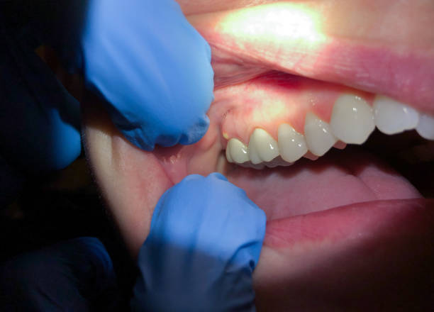 Best Same-Day Emergency Dentist in North Wilkesboro, NC